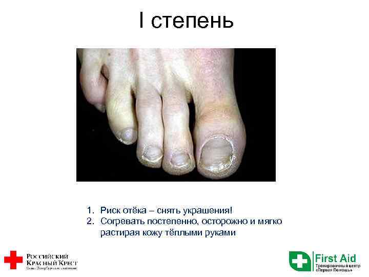 I степень 1. Риск отёка – снять украшения! 2. Согревать постепенно, осторожно и мягко