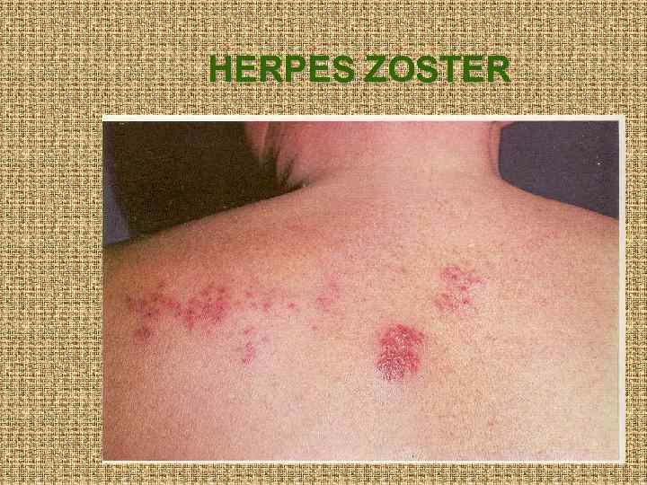 HERPES ZOSTER 