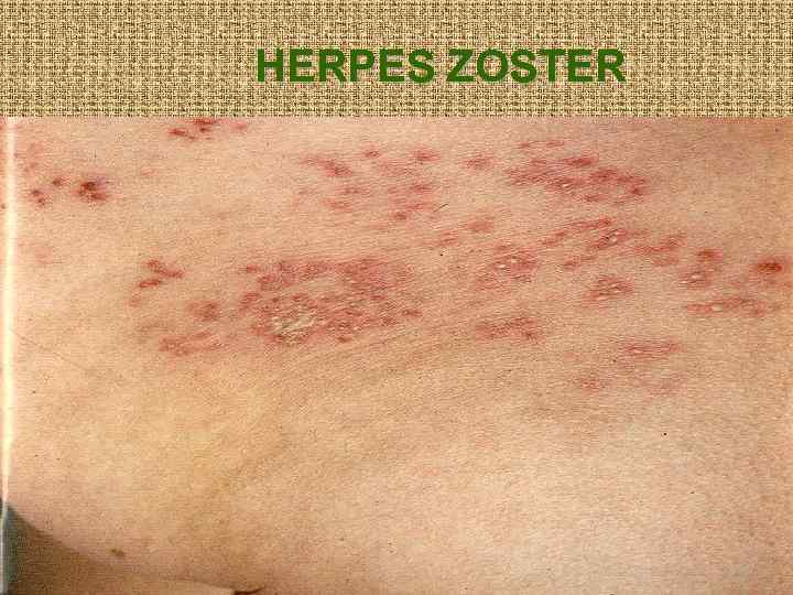 HERPES ZOSTER 