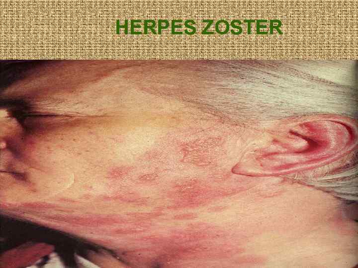 HERPES ZOSTER 