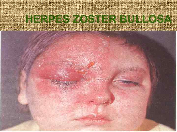 HERPES ZOSTER BULLOSA 