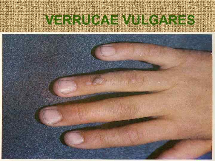 VERRUCAE VULGARES 