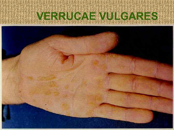 VERRUCAE VULGARES 