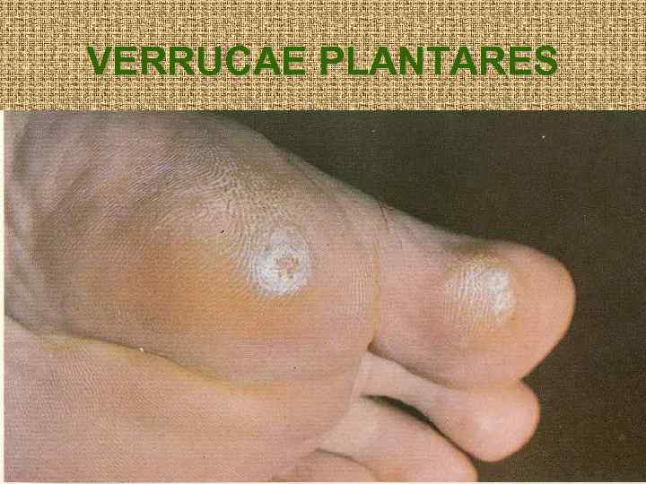 VERRUCAE PLANTARES 