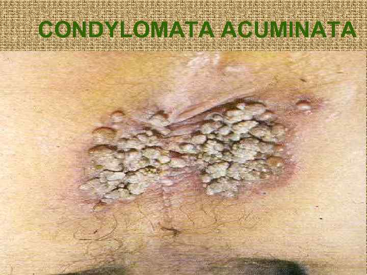 CONDYLOMATA ACUMINATA 