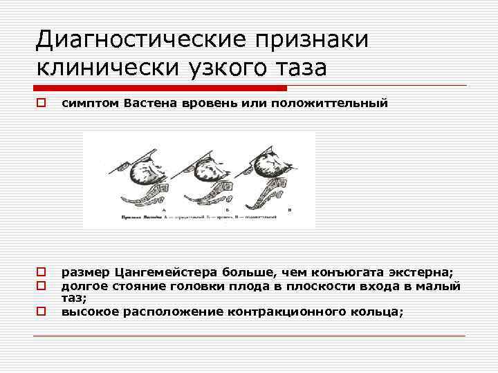 Диагностические признаки клинически узкого таза o симптом Вастена вровень или положиттельный o o размер