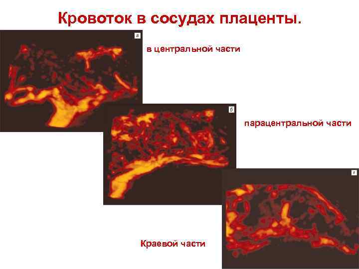 Кровоток в сосудах плаценты. в центральной части парацентральной части Краевой части 