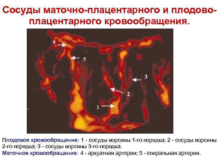 Сосуды маточно-плацентарного и плодовоплацентарного кровообращения. Плодовое кровообращение: 1 - сосуды ворсины 1 -го порядка;