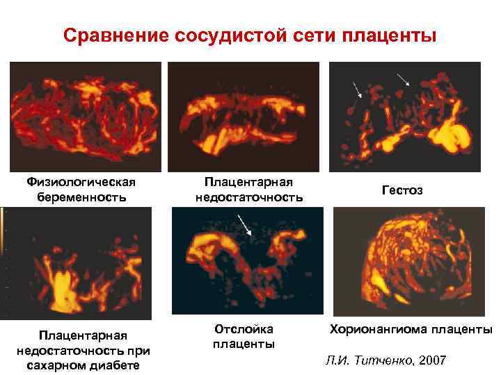 Сравнение сосудистой сети плаценты Физиологическая беременность Плацентарная недостаточность при сахарном диабете Плацентарная недостаточность Отслойка