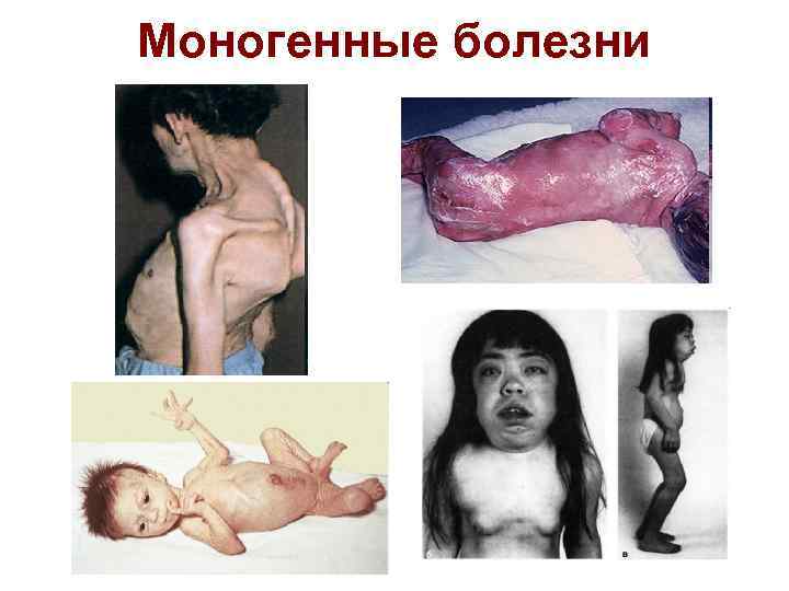 Моногенные болезни 