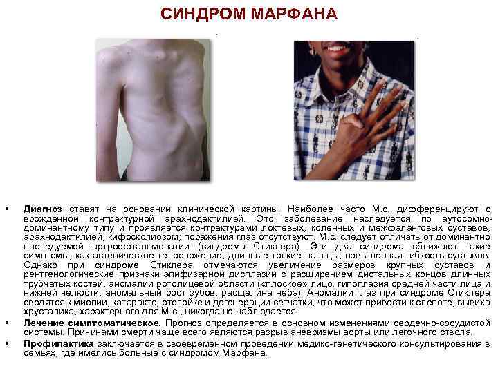 СИНДРОМ МАРФАНА • • • Диагноз ставят на основании клинической картины. Наиболее часто М.