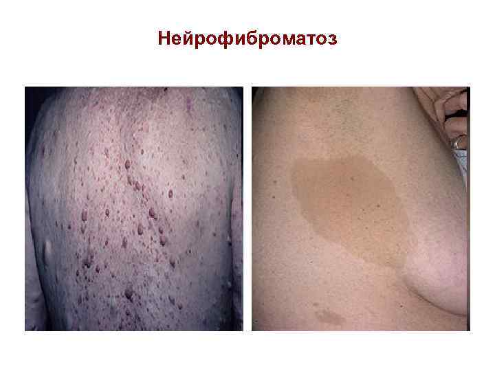 Нейрофиброматоз 