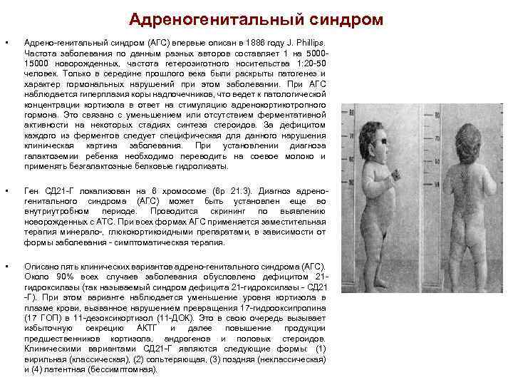Адреногенитальный синдром • Адрено-генитальный синдром (АГС) впервые описан в 1886 году J. Phillips. Частота