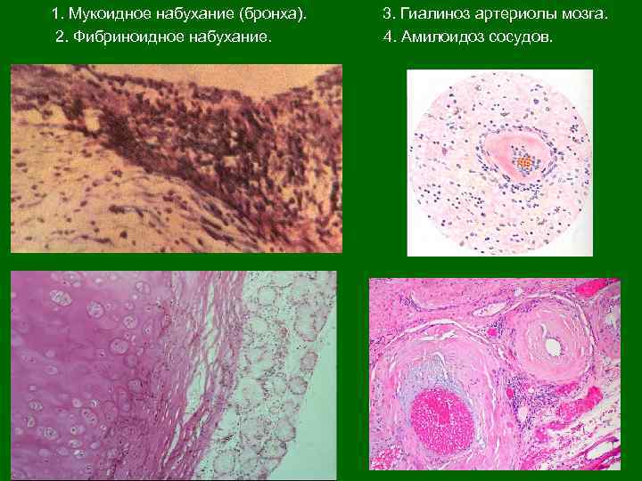  1. Мукоидное набухание (бронха). 3. Гиалиноз артериолы мозга. 2. Фибриноидное набухание. 4. Амилоидоз