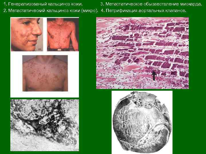  1. Генерализованый кальциноз кожи. 3. Метастатическое обызвествление миокарда. 2. Метастатический кальциноз кожи (микро).