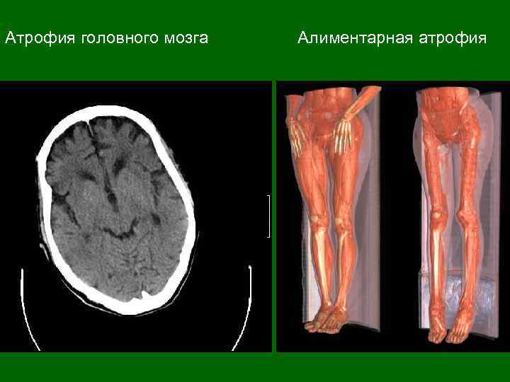 Атрофия головного мозга Алиментарная атрофия 