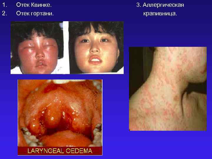1. 2. Отек Квинке. Отек гортани. 3. Аллергическая крапивница. 