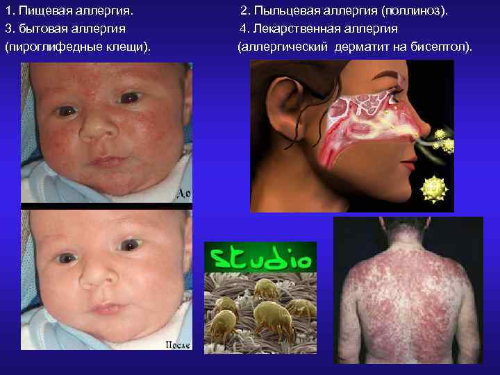 1. Пищевая аллергия. 3. бытовая аллергия (пироглифедные клещи). 2. Пыльцевая аллергия (поллиноз). 4. Лекарственная