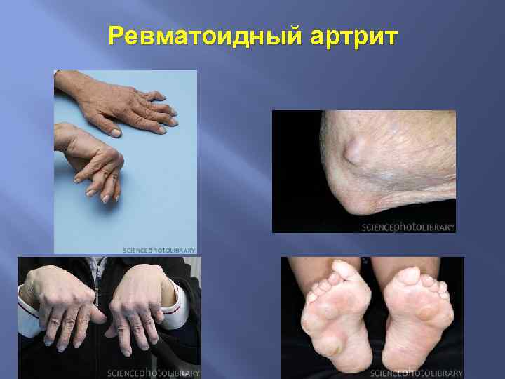 Ревматоидный артрит 