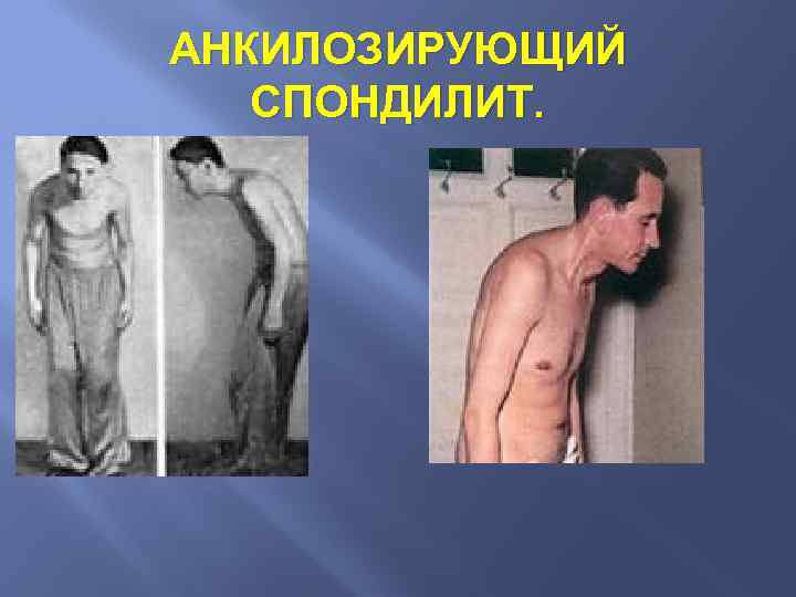 АНКИЛОЗИРУЮЩИЙ СПОНДИЛИТ. 