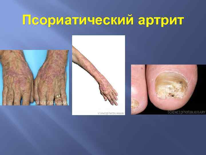 Псориатический артрит 