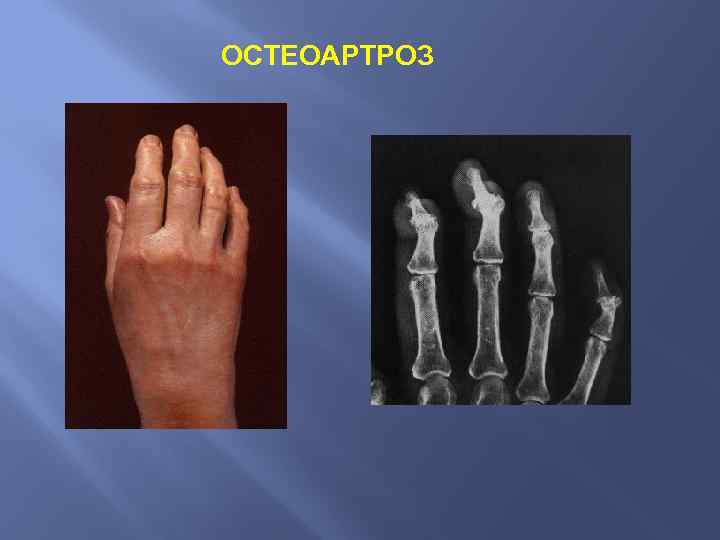 ОСТЕОАРТРОЗ 