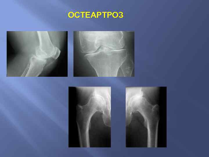 ОСТЕАРТРОЗ 