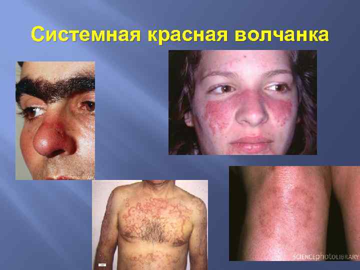 Системная красная волчанка 