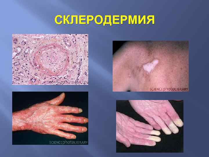 СКЛЕРОДЕРМИЯ 