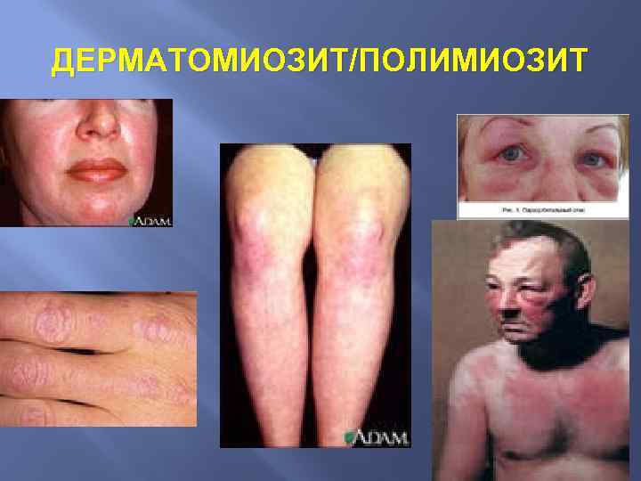 ДЕРМАТОМИОЗИТ/ПОЛИМИОЗИТ 