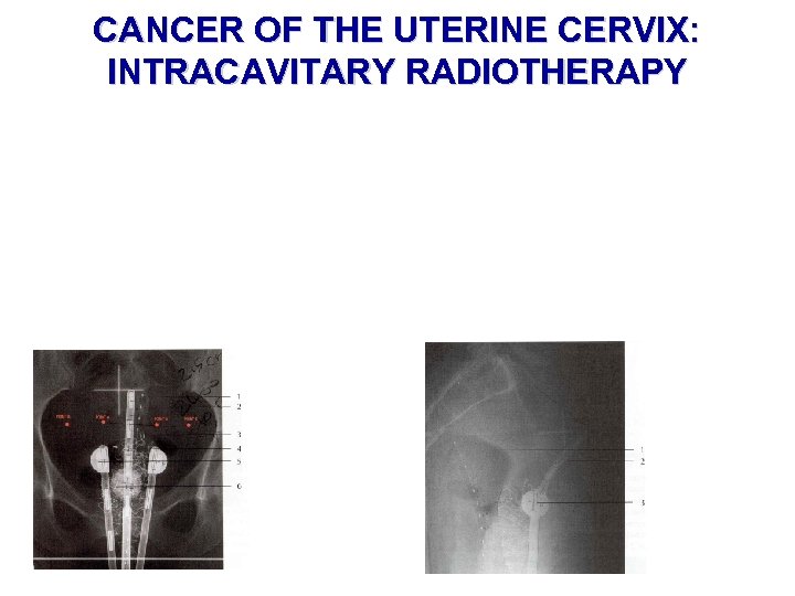 CANCER OF THE UTERINE CERVIX: INTRACAVITARY RADIOTHERAPY 