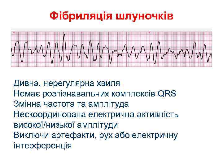 Фібриляція шлуночків Дивна, нерегулярна хвиля Немає розпізнавальних комплексів QRS Змінна частота та амплітуда Нескоординована