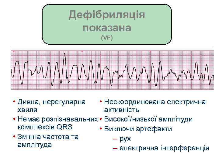Дефібриляція показана (VF) • Дивна, нерегулярна • Нескоординована електрична хвиля активність • Немає розпізнавальних