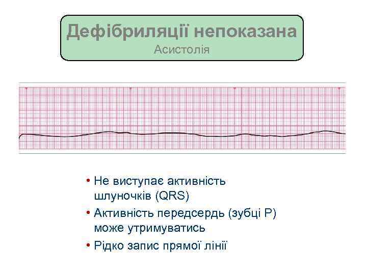 Дефібриляції непоказана Асистолія • Не виступає активність шлуночків (QRS) • Активність передсердь (зубці P)