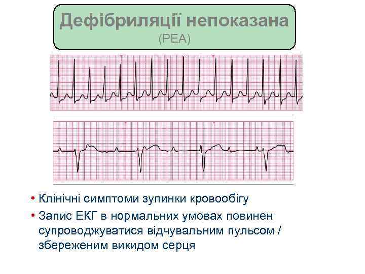 Дефібриляції непоказана (PEA) • Клінічні симптоми зупинки кровообігу • Запис ЕКГ в нормальних умовах