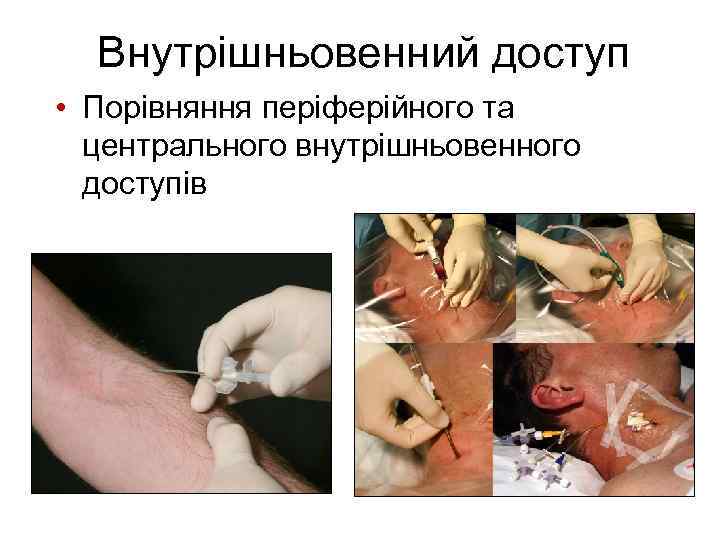 Внутрішньовенний доступ • Порівняння періферійного та центрального внутрішньовенного доступів 