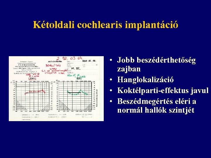 Kétoldali cochlearis implantáció • Jobb beszédérthetőség zajban • Hanglokalizáció • Koktélparti-effektus javul • Beszédmegértés