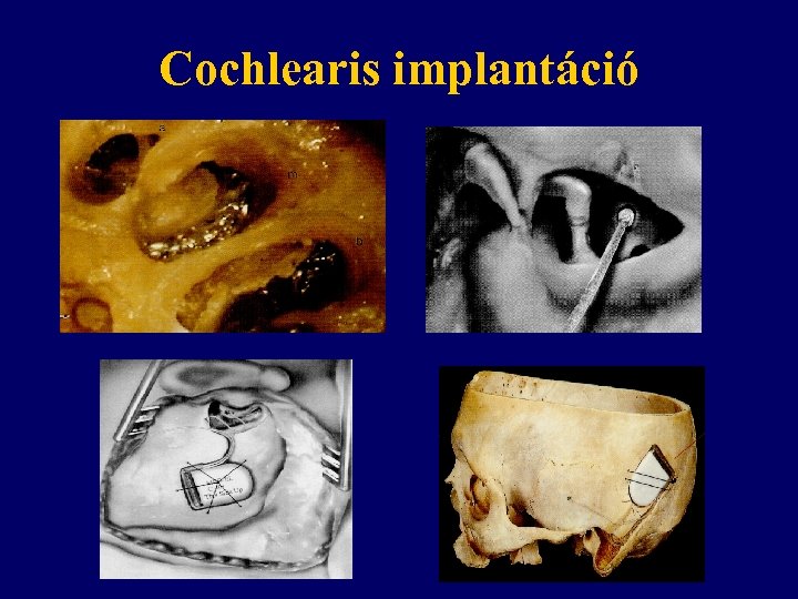Cochlearis implantáció 