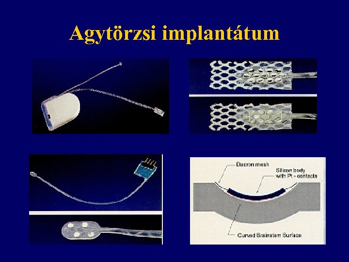 Agytörzsi implantátum 