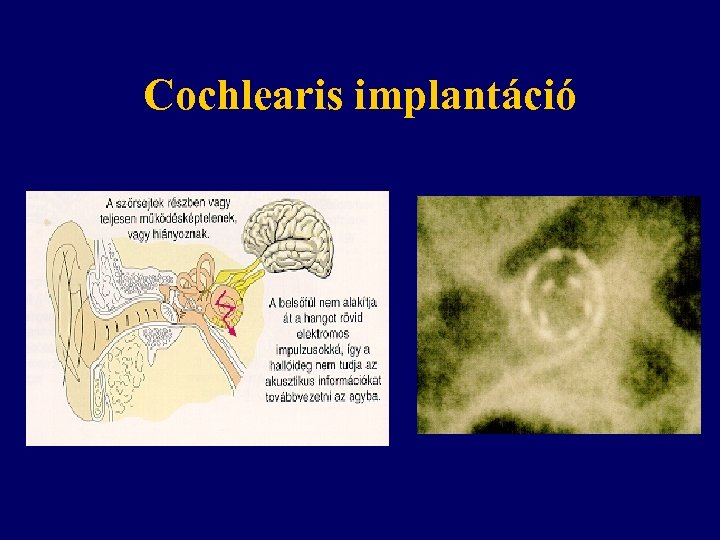 Cochlearis implantáció 