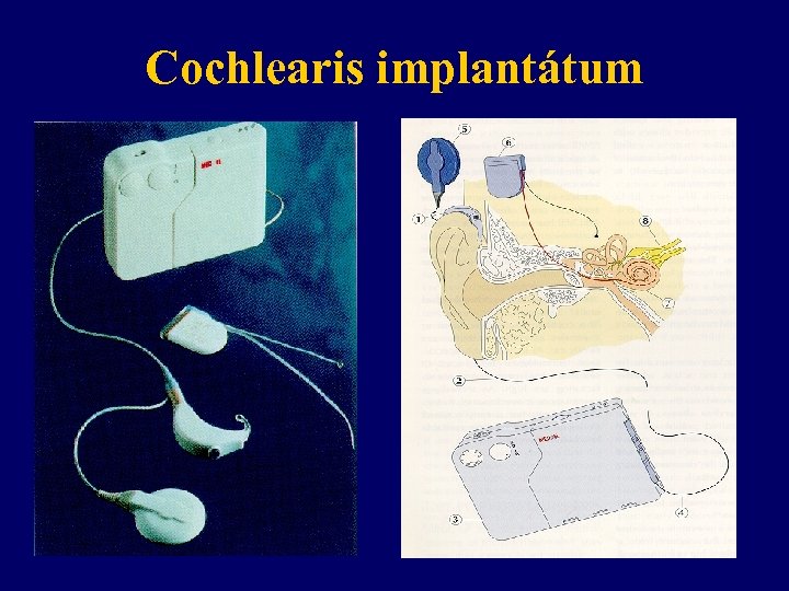 Cochlearis implantátum 