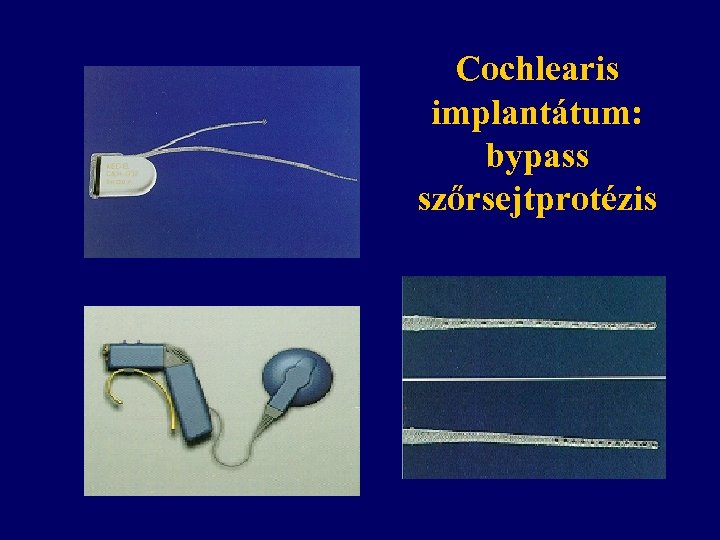 Cochlearis implantátum: bypass szőrsejtprotézis 