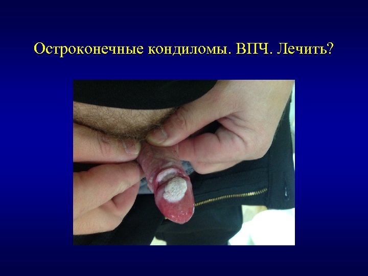 Остроконечные кондиломы. ВПЧ. Лечить? 
