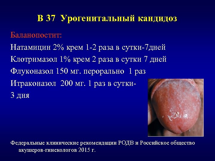 В 37 Урогенитальный кандидоз Баланопостит: Натамицин 2% крем 1 -2 раза в сутки-7 дней