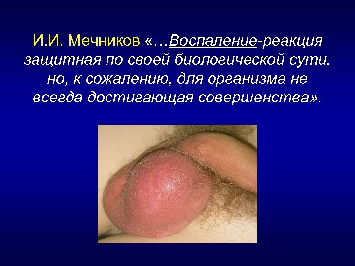 И. И. Мечников «…Воспаление-реакция защитная по своей биологической сути, но, к сожалению, для организма