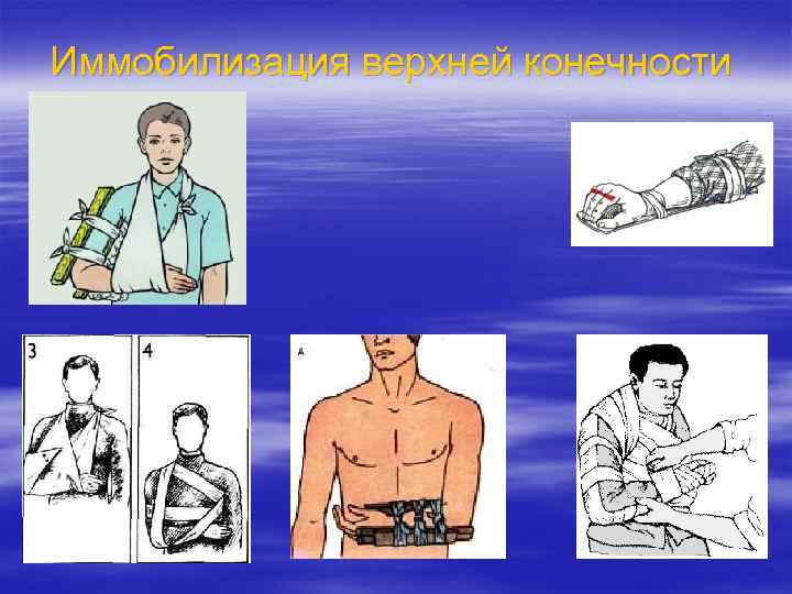 Иммобилизация верхней конечности 