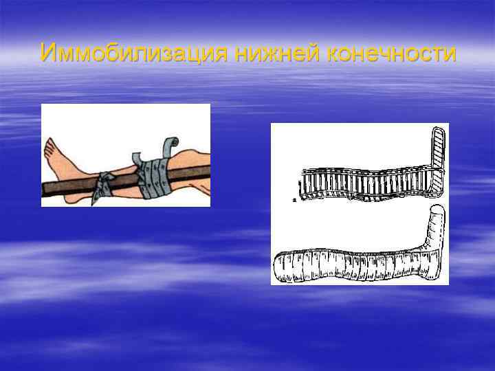Иммобилизация нижней конечности 