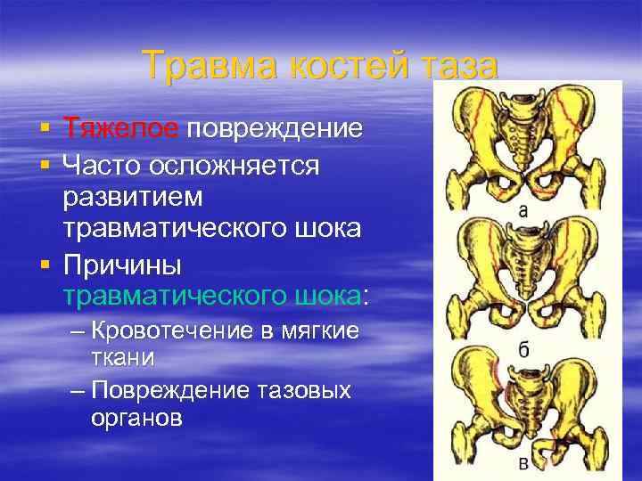 Травма костей таза § Тяжелое повреждение § Часто осложняется развитием травматического шока § Причины