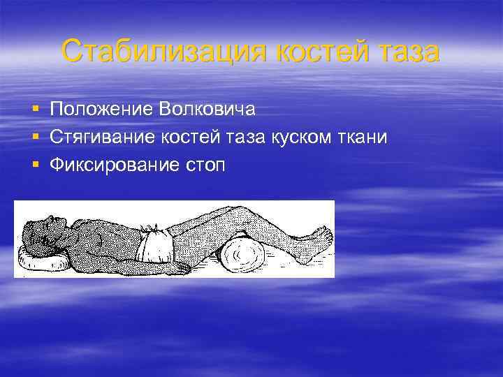 Стабилизация костей таза § Положение Волковича § Стягивание костей таза куском ткани § Фиксирование