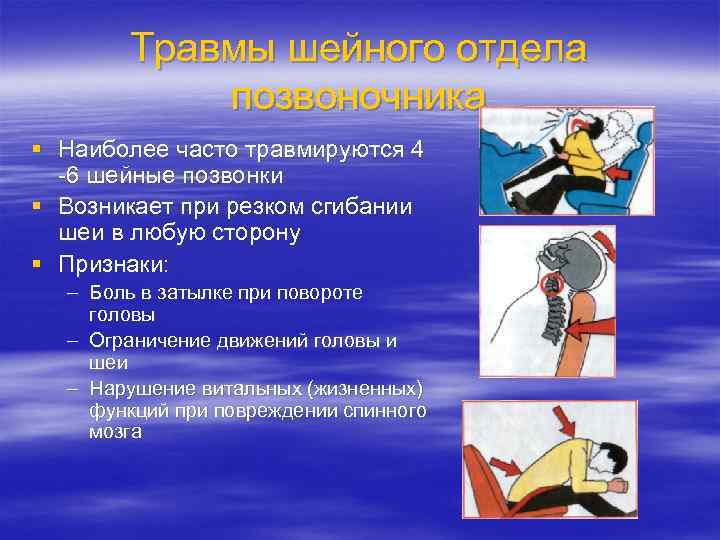 Травмы шейного отдела позвоночника § Наиболее часто травмируются 4 -6 шейные позвонки § Возникает